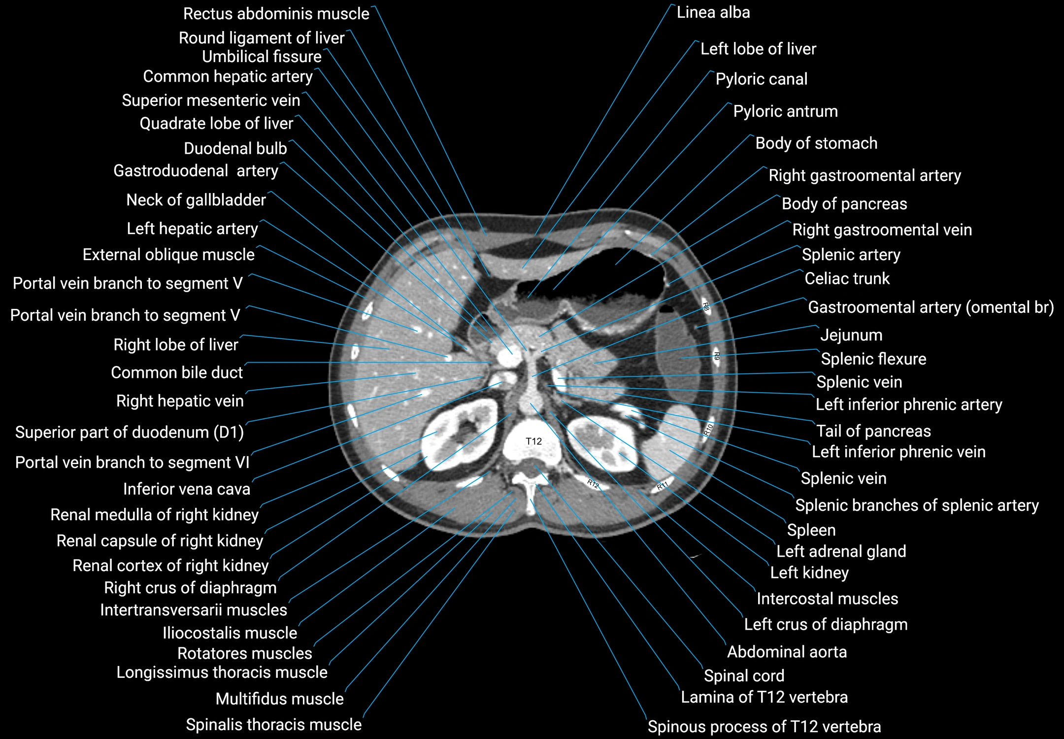 CT male pelvis axial cross sectional anatomy labelled radiology image -00047.webp